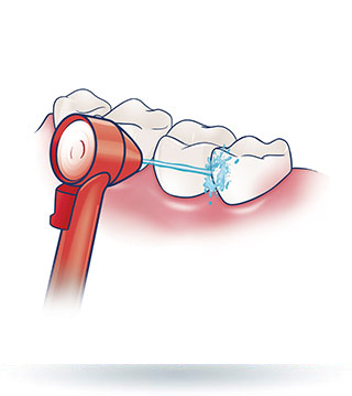 Irygacja między szczelinami zębów