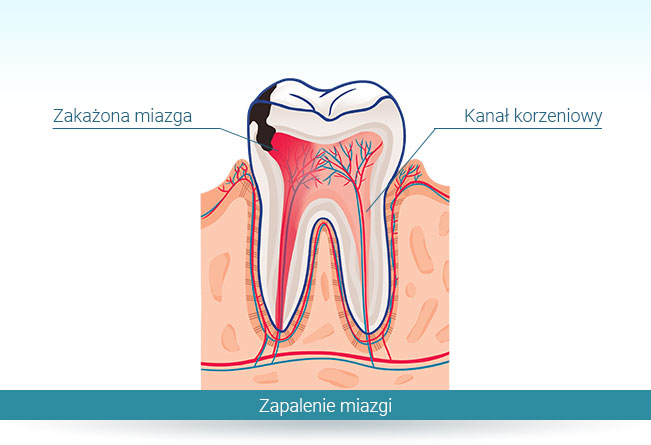 Zapalenie miazgi w strukturze zęba